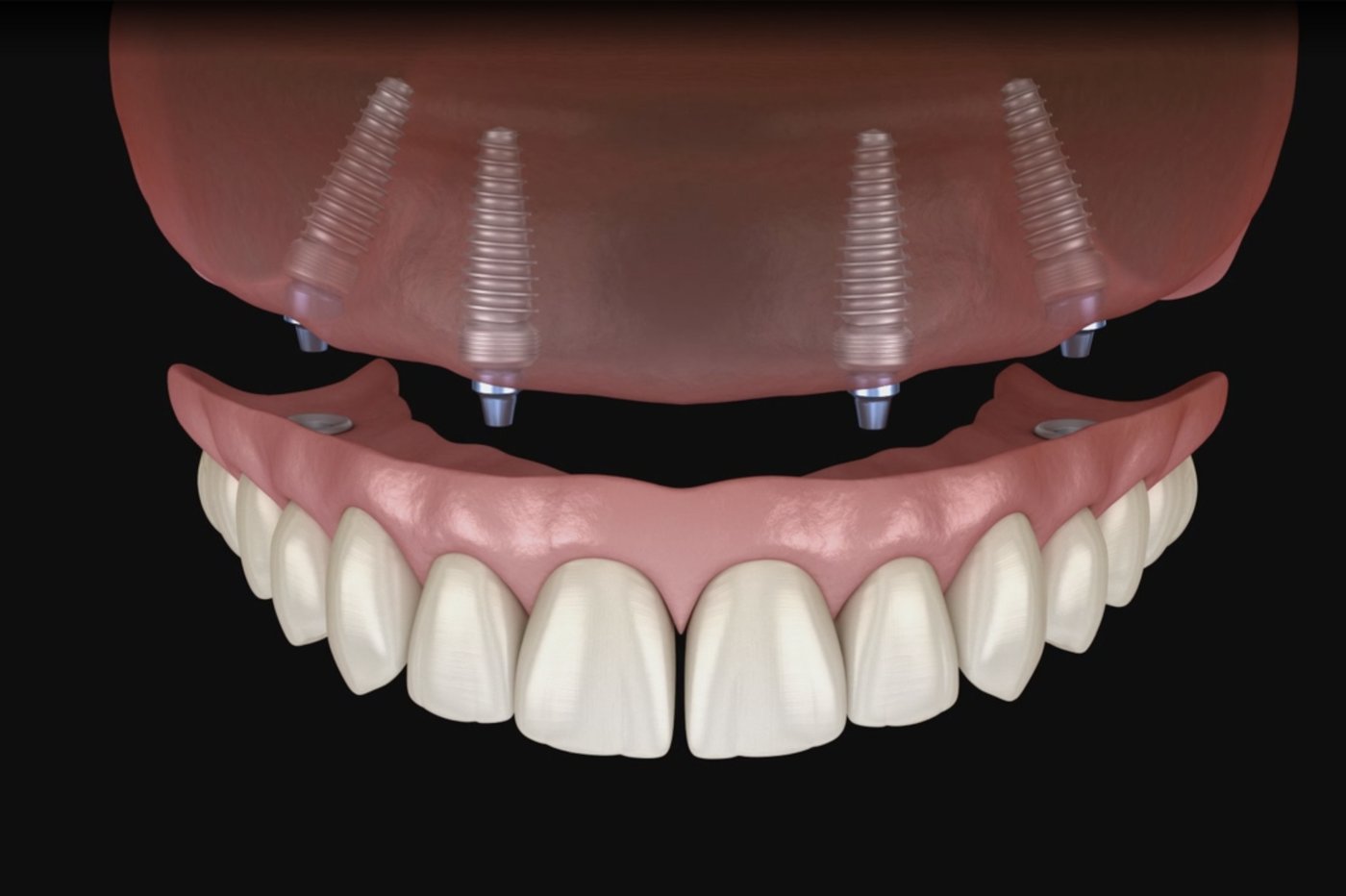All-on-4 full-arch dental implant bridge showing a complete row of replacement teeth supported by four implants