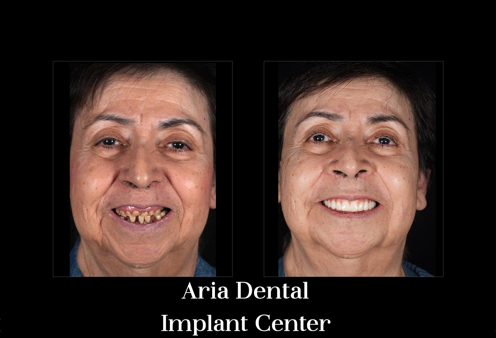 Before and after smile transformation of a real Aria Dental Implant Center patient