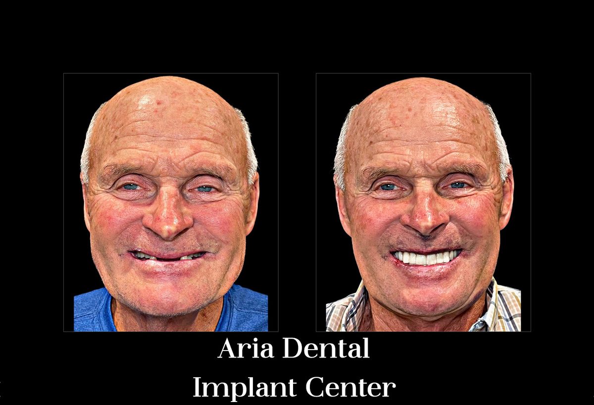 Before and after smile transformation of a real Aria Dental Implant Center patient