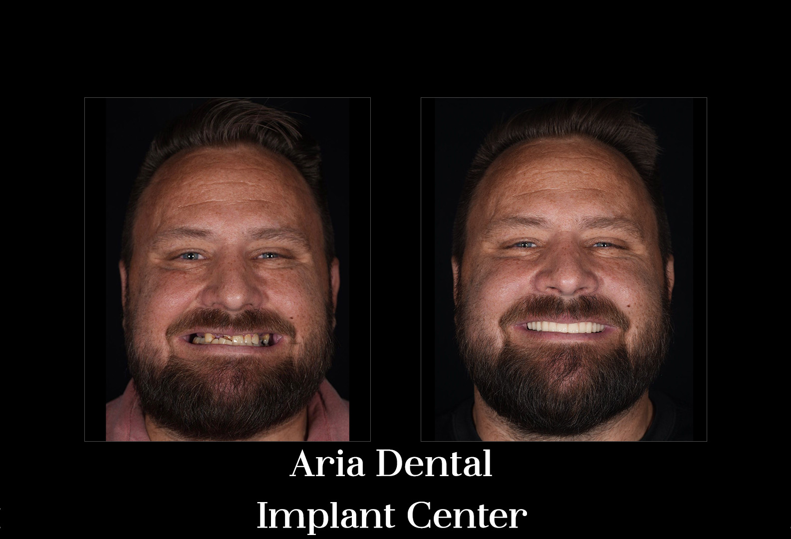 Before and after smile transformation of a real Aria Dental Implant Center patient