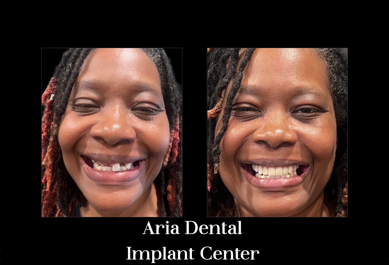 Before and after smile transformation — Aria Dental Implant Center patient