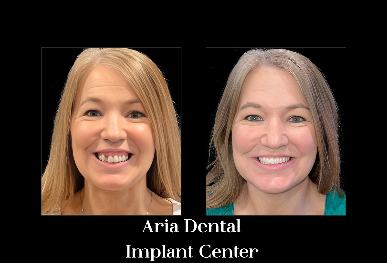 Before and after — Aria Dental Implant Center patient