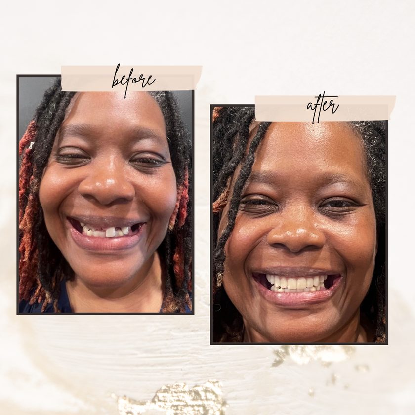 Documented before and after dental implant results at Aria Dental Implant Center in Phoenix