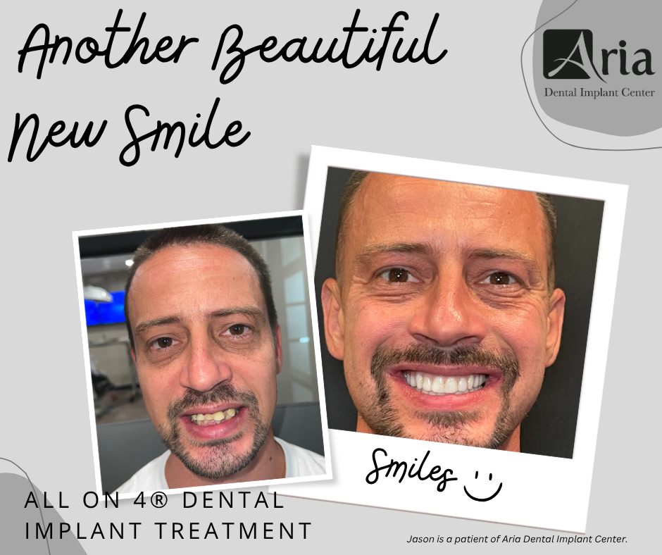 All-on-4® fixed full-arch dental implant patient before and after treatment at Aria Dental Implant Center in Phoenix, Arizona