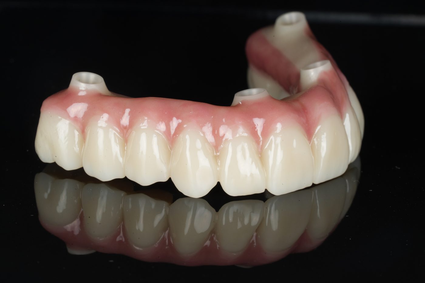 Zirconia implant bridge shaped so gum tissue contours naturally around the restoration, crafted at Aria Dental Implant Center in Phoenix, Arizona