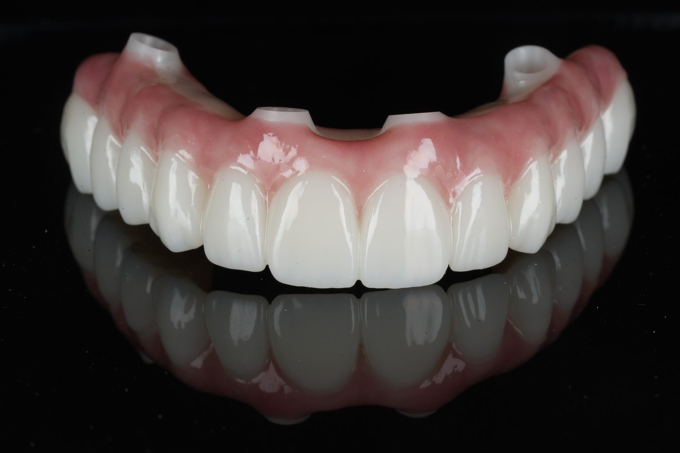 NobelProcera zirconia implant bridge in a bright white shade — front view, Aria Dental Implant Center
