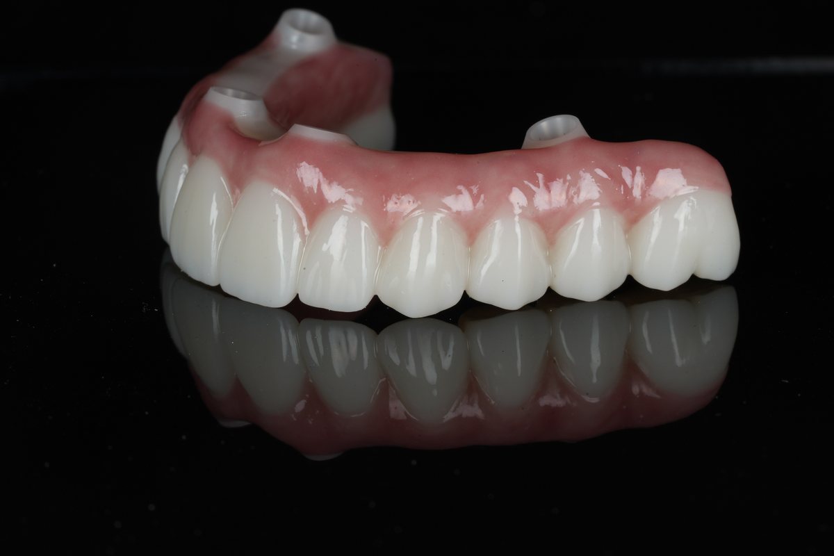 NobelProcera zirconia implant bridge in a bright white shade — angled view, Aria Dental Implant Center