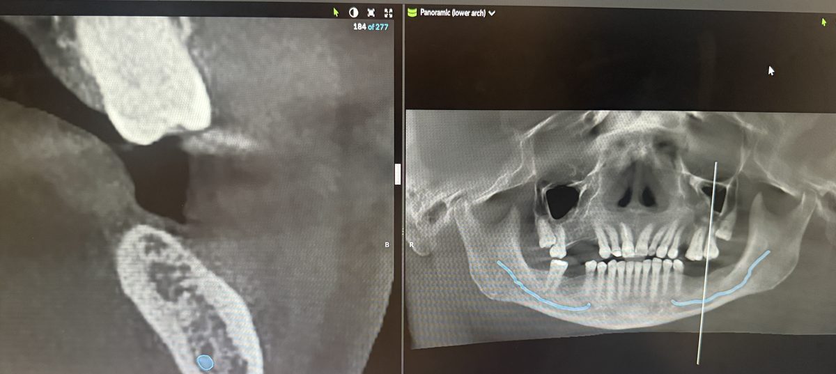 3D CBCT scan used to plan bone grafting for dental implants at Aria Dental Implant Center in Phoenix, Arizona
