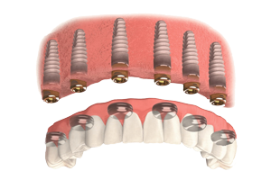 6 Implant Overdenture - Upper