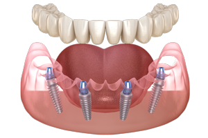 All-on-4 Dental Implants