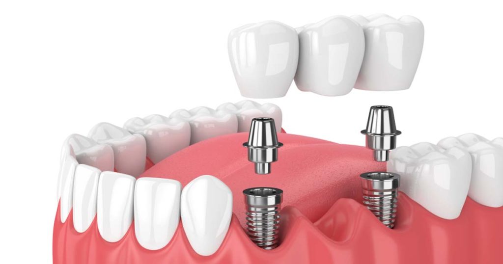 Dental Implants Illustration