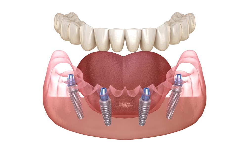 all one 4 denture implants illustration