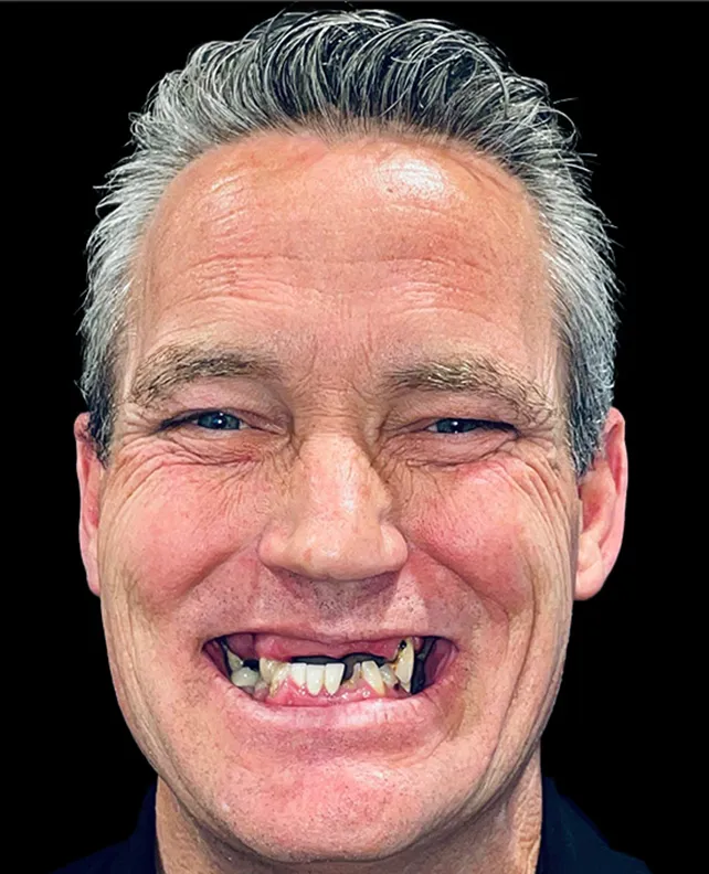 02-dental-implant-patient-before dental implant patient before