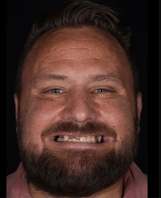 03-dental-implant-patient-before dental implant patient before