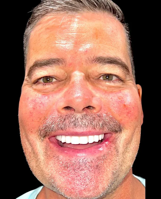 dental implant patient after