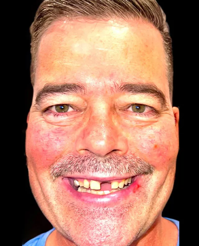 dental implant patient before