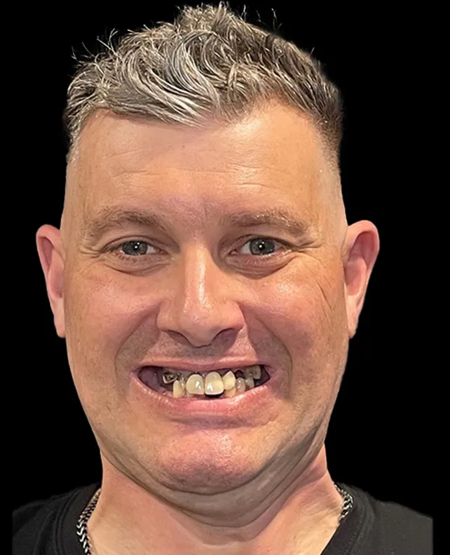 dental implant patient before