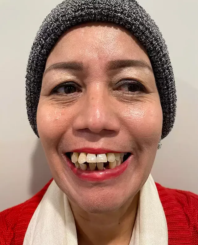 Dental implant patient before