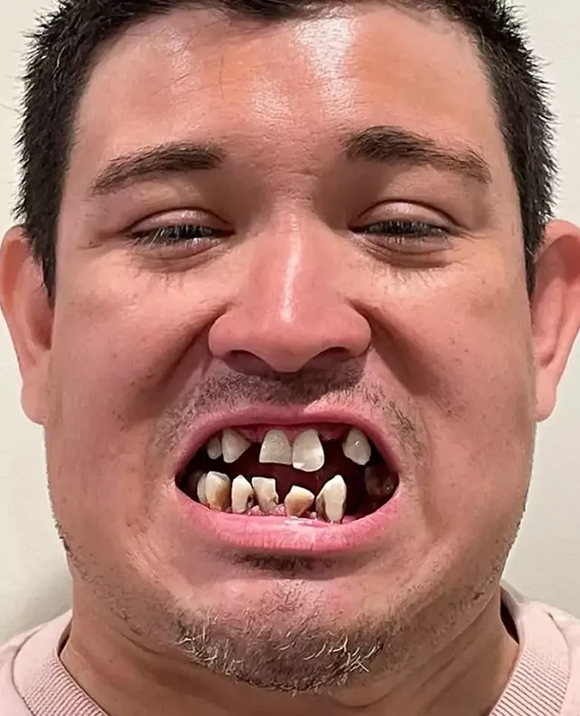 Dental implant patient - before