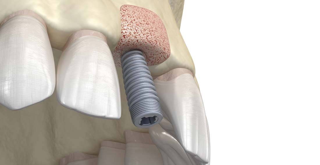 bone graft illustration