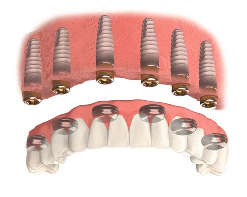 implant overdenture upper